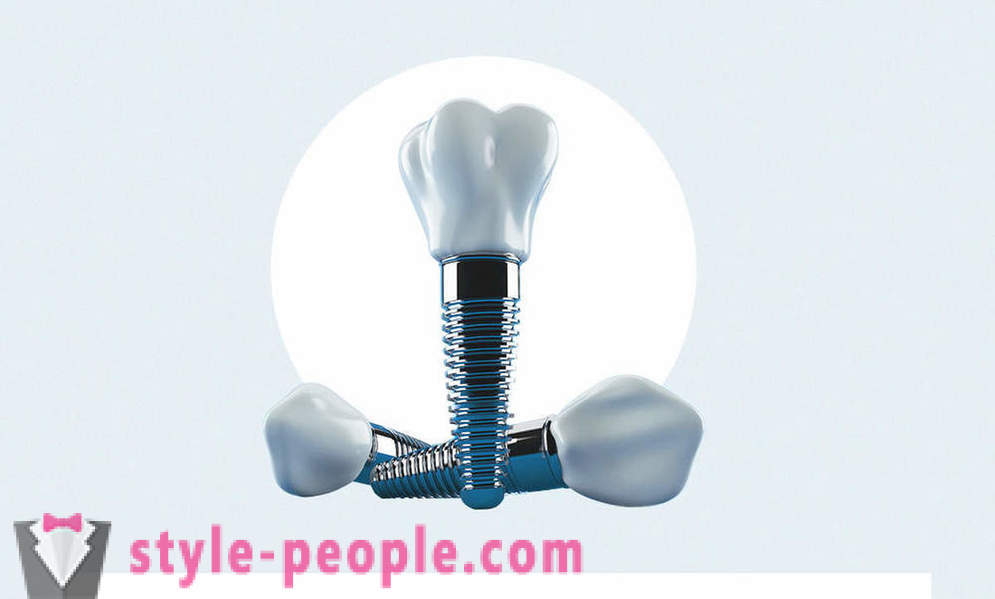 8 klausimus apie dantų implantų