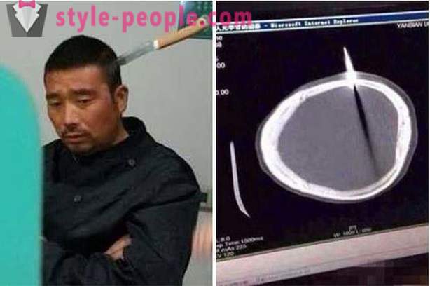 Kinų vyras su į galvą peiliu jis išvyko į gydytoją
