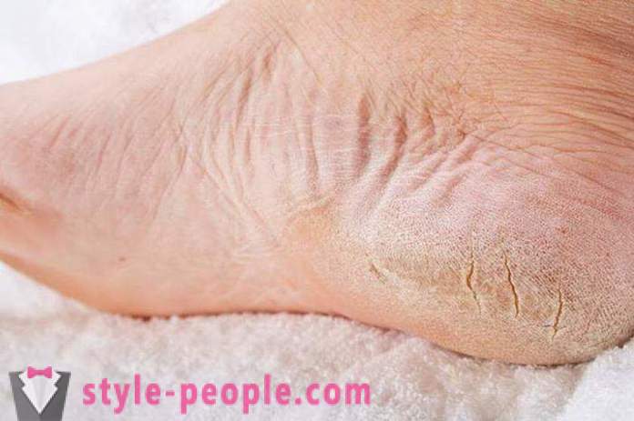 Sausa oda ant kojų: priežastys